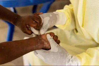 رواندا ترصد أربع حالات إصابة بجدري القردة