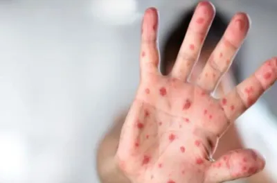 داء الحصبة.. ثلاثة أسئلة لمسؤول بالمديرية الجهوية لوزارة الصحة والحماية الاجتماعية بالدار البيضاء - سطات