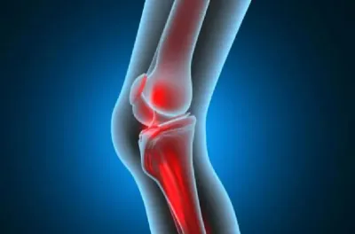 علماء يبتكرون مادة مسامية لتسريع شفاء العظام