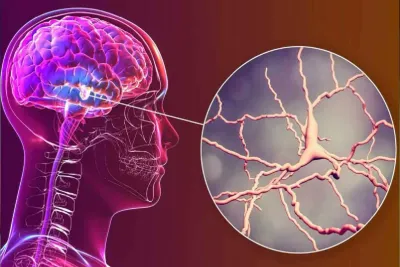 علماء يطورون غرسة دماغية تخفف الألم المزمن