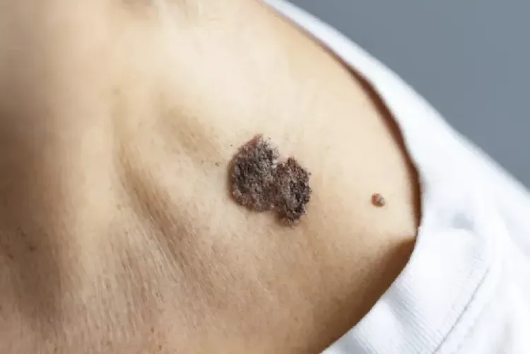 الولايات المتحدة.. الكشف عن علاج جديد لسرطان الجلد المقاوم للأدوية