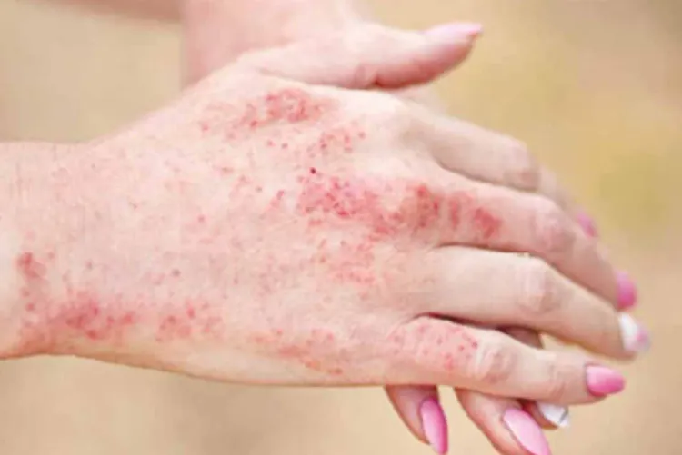 دراسة أمريكية تكشف عن تحسن أعراض مرض "الذئبة الحمراء" مع تقدم العمر