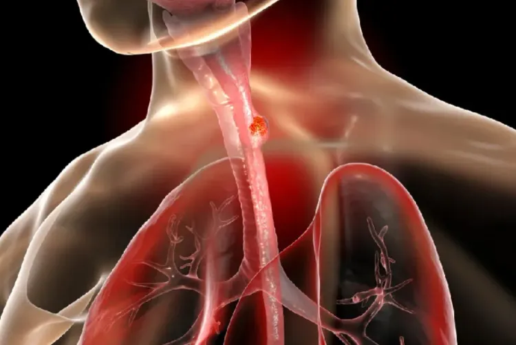 علماء يطورون كبسولة للكشف المبكر عن سرطان المريء