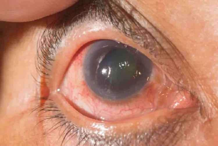 مكملات فيتامين (ب) قد تبطئ تطور مرض الجلوكوما (دراسة)