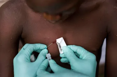 Mpox: L'OIM lance un appel de fonds pour une aide d'urgence aux populations touchées