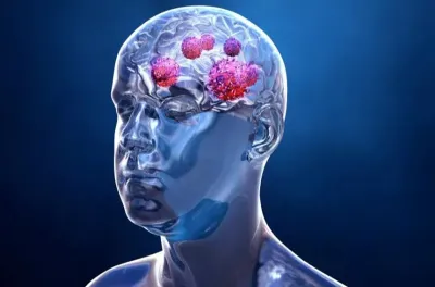 Canada: Des scientifiques annoncent un traitement novateur contre la forme la plus agressive de cancer du cerveau